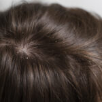 Dandruff treatment at home