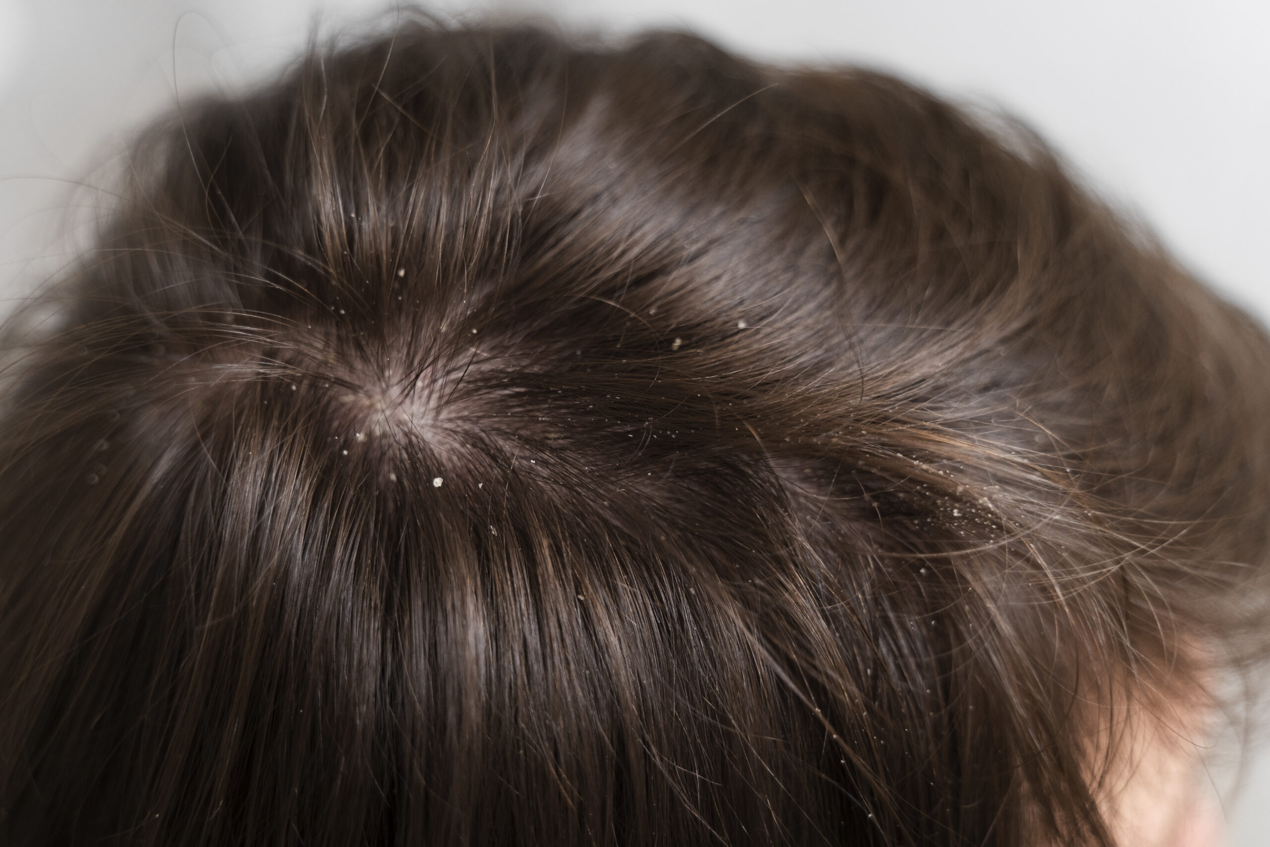 Dandruff treatment at home